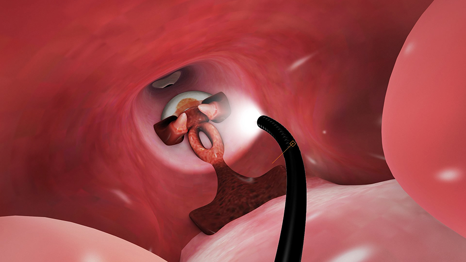 醫(yī)療器械 無菌支氣管鏡三維動(dòng)畫