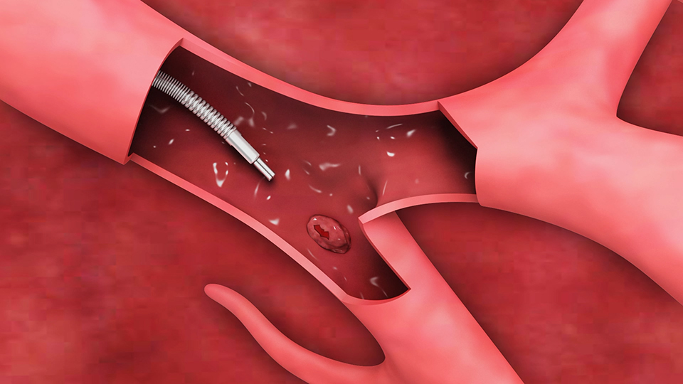 醫(yī)療器械 無菌支氣管鏡三維動(dòng)畫